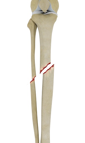 Tibial Shaft Fracture