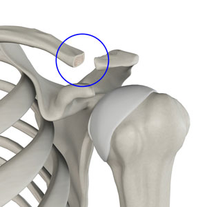 Distal Clavicle Excision