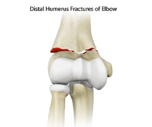 Distal Humerus Fractures of the Elbow