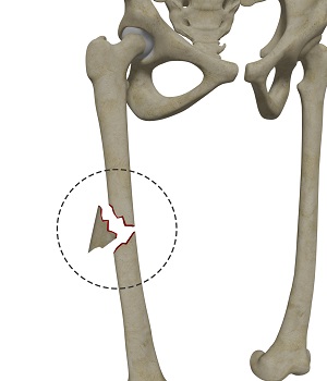 Femoral Shaft Fracture