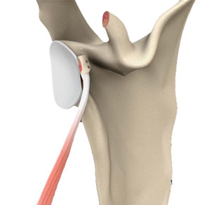 Latarjet Procedure