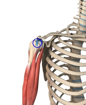 Proximal Biceps Tendon Rupture