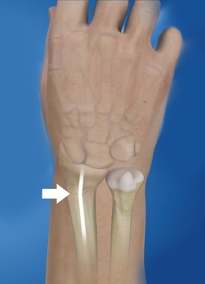 Malunion of a Fracture