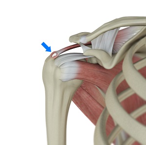 Rotator Cuff Calcification