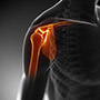 Post-traumatic Stiffness of the Shoulder