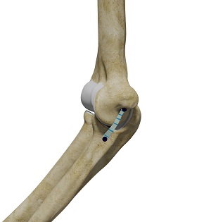 Ulnar Collateral Ligament (UCL) Repair with Internal Brace